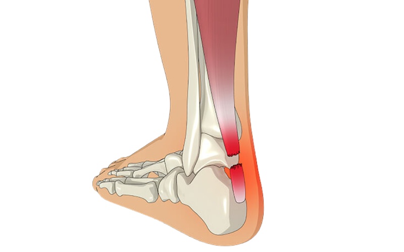 Viêm gân gót chân Achilles