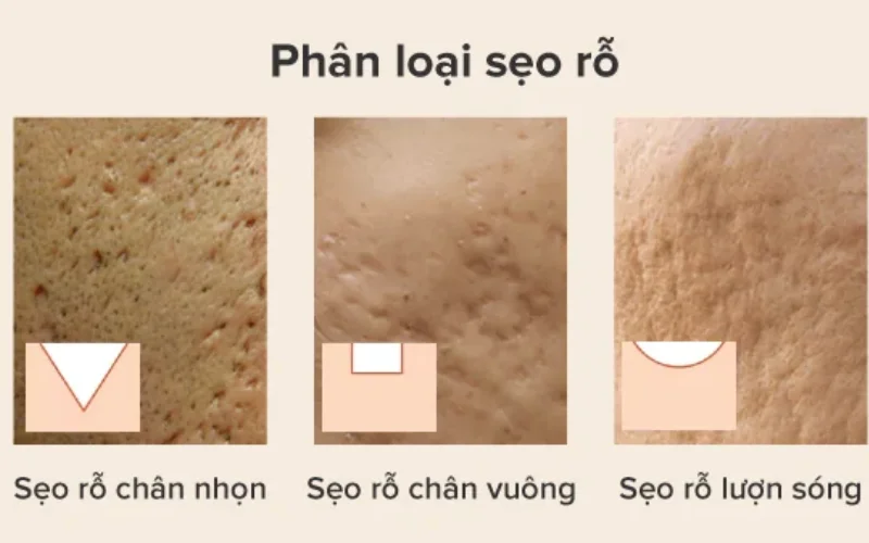 Các loại sẹo rỗ phổ biến