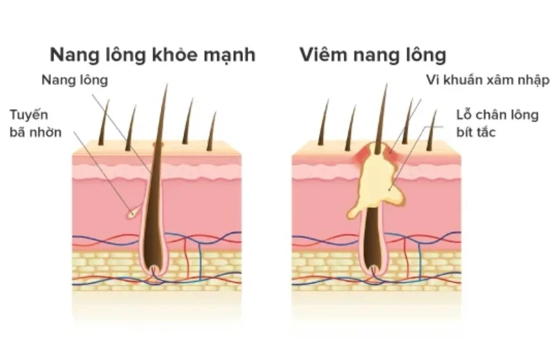 Cách cải thiện viêm nang lông ở bắp tay