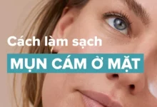 Chuyên gia chia sẻ cách làm sạch mụn cám ở mặt hiệu quả