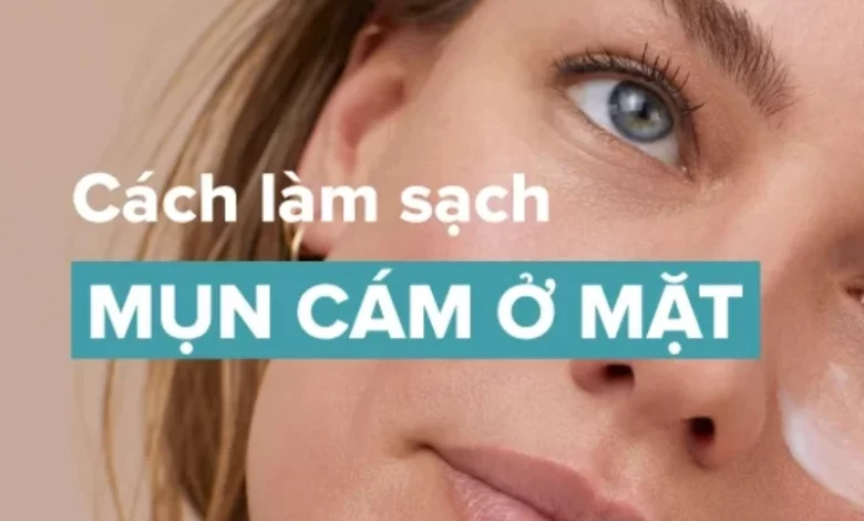 Chuyên gia chia sẻ cách làm sạch mụn cám ở mặt hiệu quả