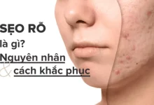 Nguyên nhân bị sẹo rỗ và cách khắc phục sẹo rỗ hiệu quả