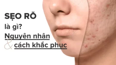 Nguyên nhân bị sẹo rỗ và cách khắc phục sẹo rỗ hiệu quả