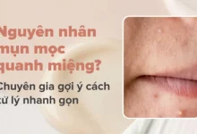 Nguyên nhân, cách điều trị mụn mọc quanh miệng và cằm