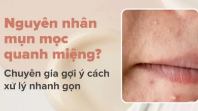 Nguyên nhân, cách điều trị mụn mọc quanh miệng và cằm