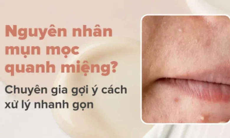 Nguyên nhân, cách điều trị mụn mọc quanh miệng và cằm