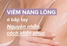 Nguyên nhân viêm nang lông ở bắp tay và cách cải thiện